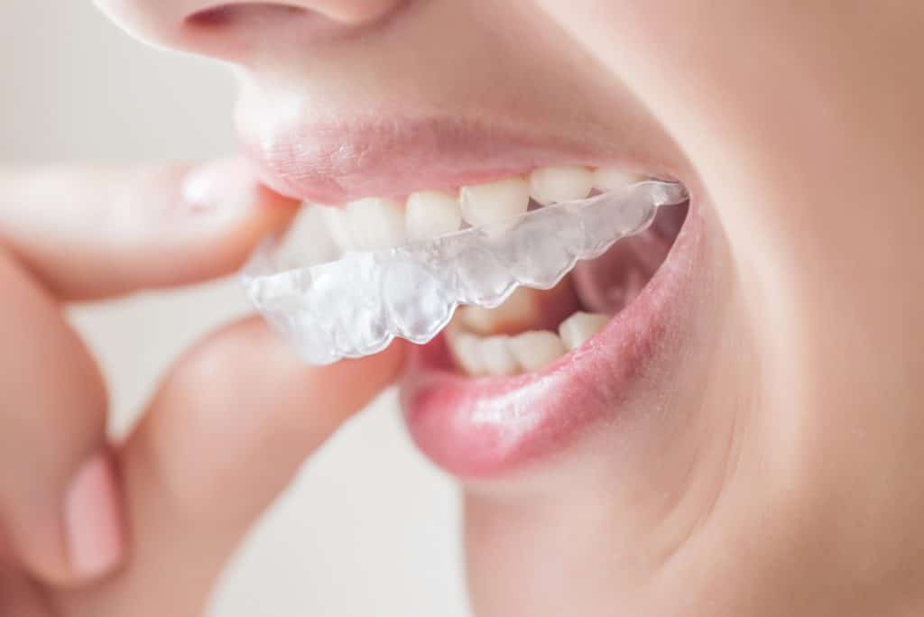 Understanding Invisalign